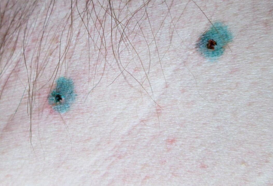Marken op der Haut no Laser Entfernung vu Papillome